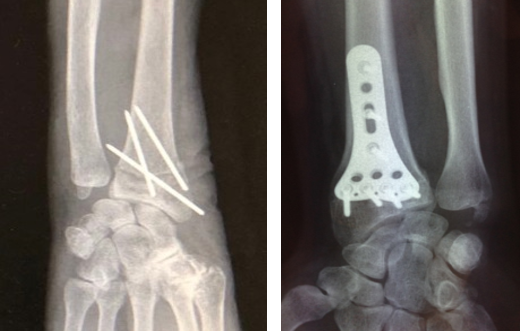 Fracture du poignet | Hôpital DCSS